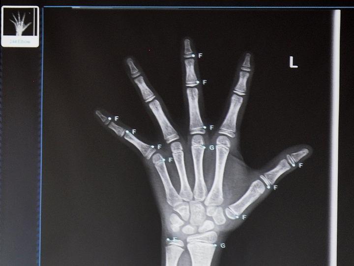 及时掌握孩子的生长空间|测试|骨龄|骨骺线_新浪新闻