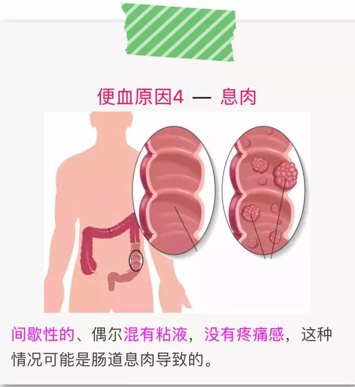 便血?肠癌还是痔疮?快来对照一下!