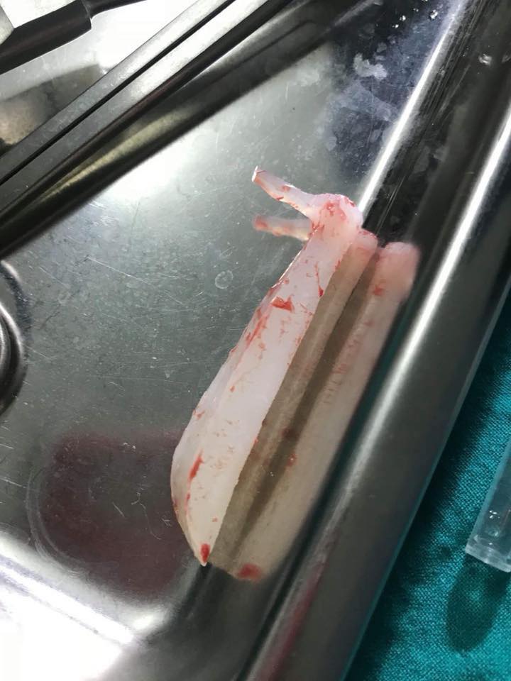 廉价隆鼻几天后"假体贯穿鼻梁外露发炎",硅胶拿出便宜到吓人!