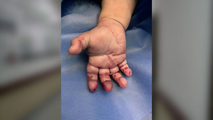 心揪着痛啊,才1岁的女孩,手指变成这么可怕!父母都看看吧