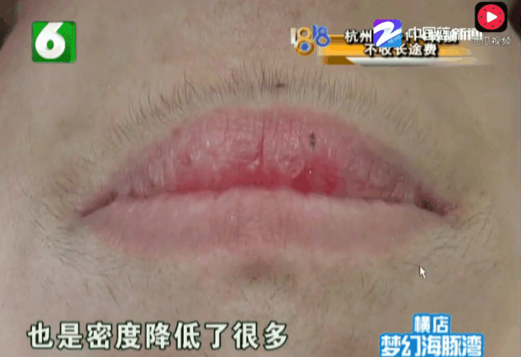 女子5次激光脱唇毛以后变成"小胡子" 医生: 手术很成功, 样子很完美