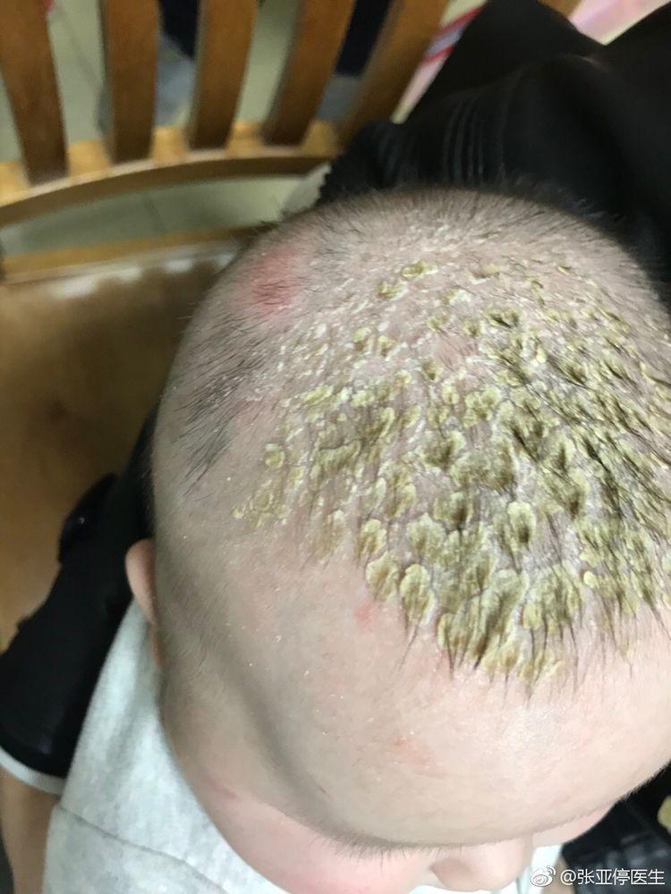 宝宝生下后, 头上长满绿色油状物, 医生一番话让妈妈态度抖转!