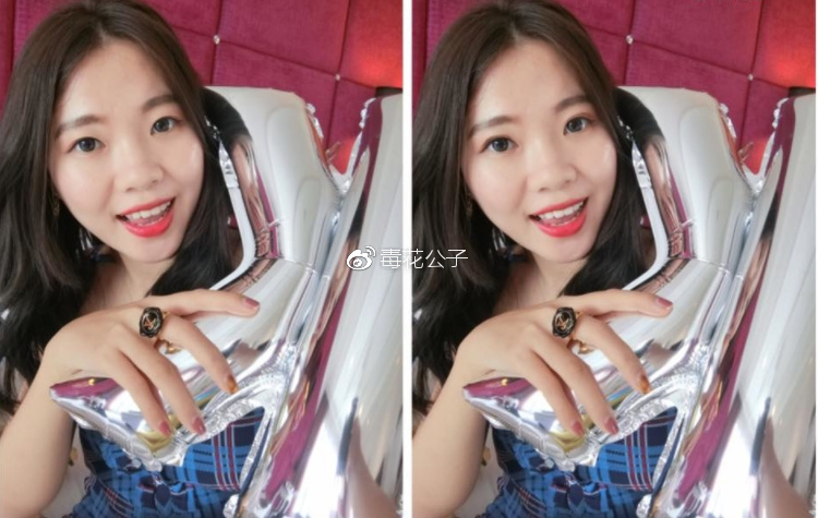 北京埋线双眼皮手术28天 前后对比恢复过程