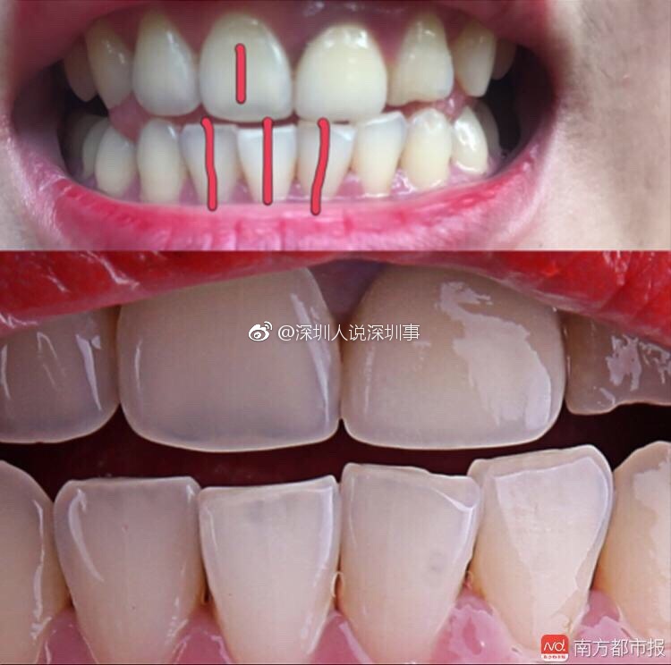 深圳90后女子洗牙后4颗门牙现裂痕 诊所称与其无关