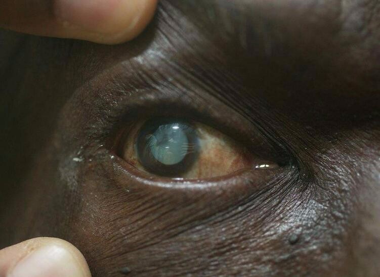 整天盯着手机电脑,轻度白内障越来越多,养眼防障要怎么做?|白内障|手