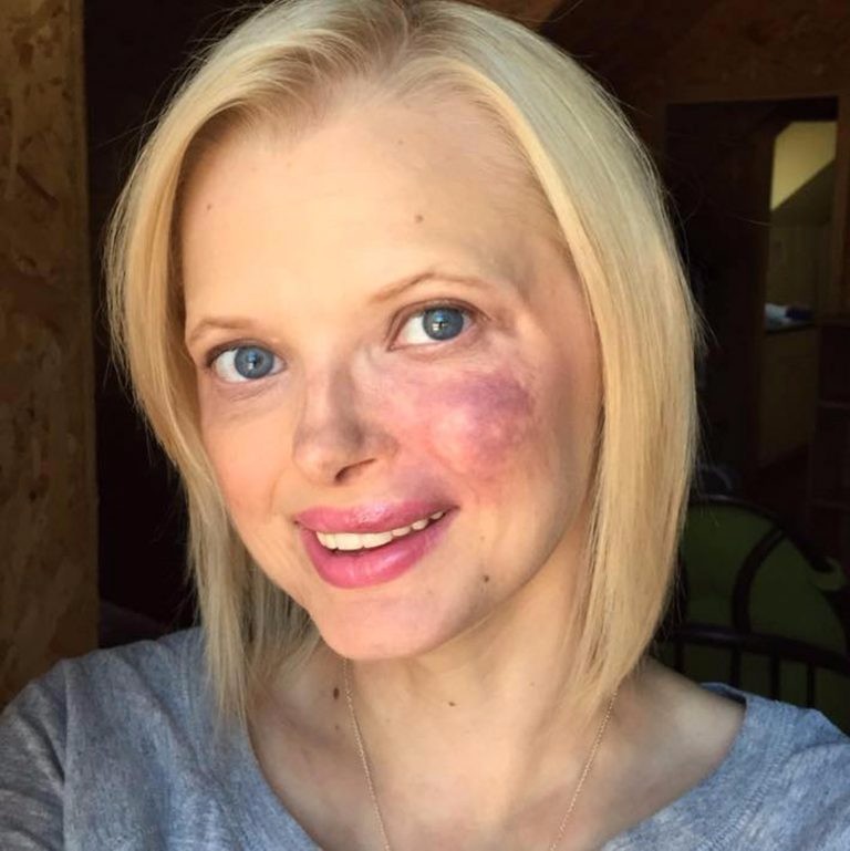 女子因脸上的胎记遭前夫抛弃,曾一度自卑如今勇敢面对获得真爱