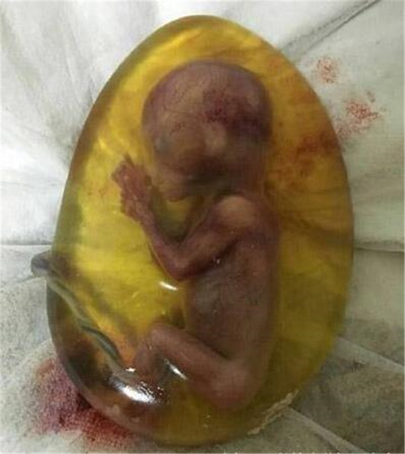 6个月胎儿人流下来图图片