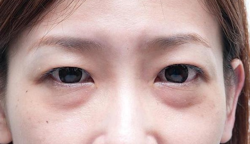 眼袋下垂别傻傻打玻尿酸,用几毛钱一瓶的液体,一周消除眼袋皱纹