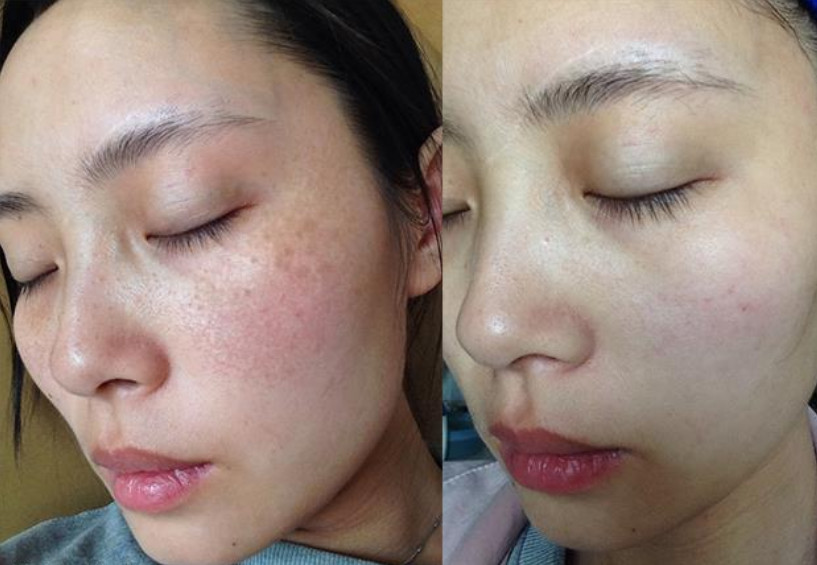 每天用三片白色的它敷面祛斑比激光强十倍一周后皮肤白净细嫩