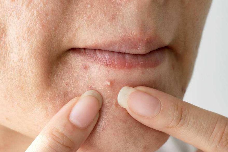 脸上长痘不是上火?激素失调才是真相,专家来教你祛痘