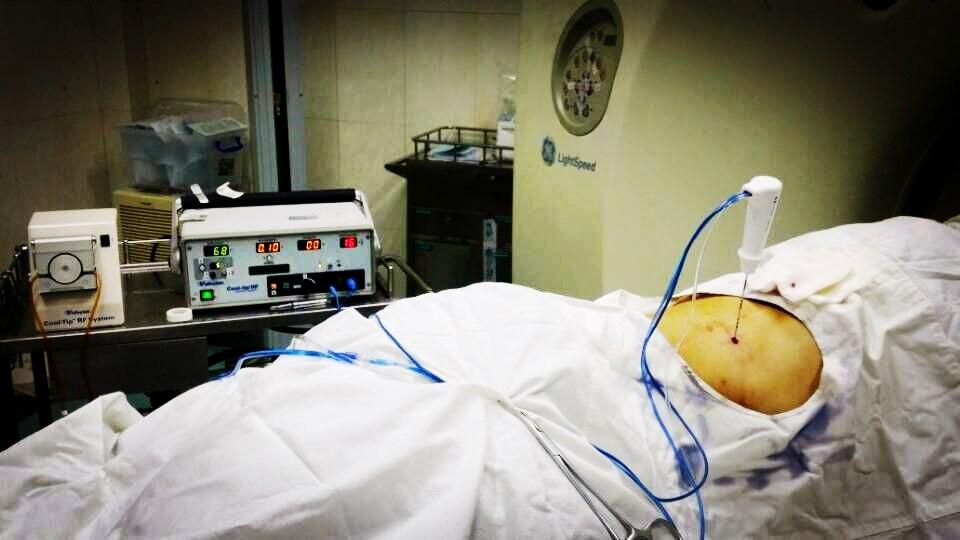 出现这8类情况需要进行肝穿刺检查