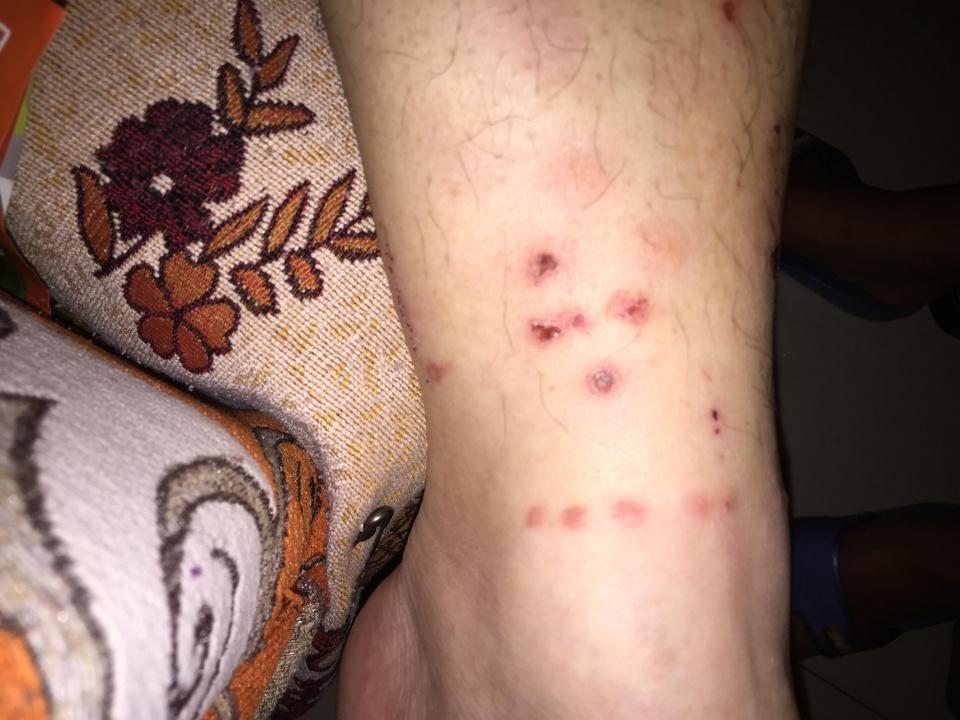 为何湿疹夜晚发作比白天严重?用中医一招,治一