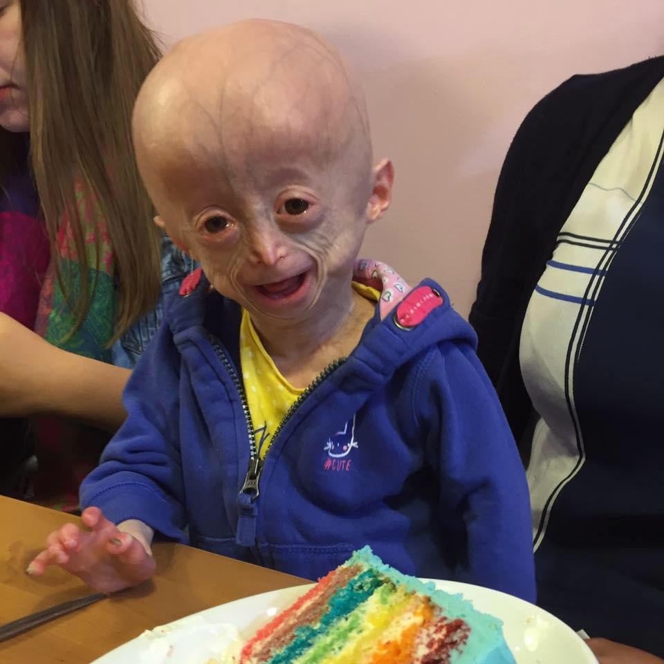 英国早老症女孩终去世,8岁女孩看上去却像60多岁老太太