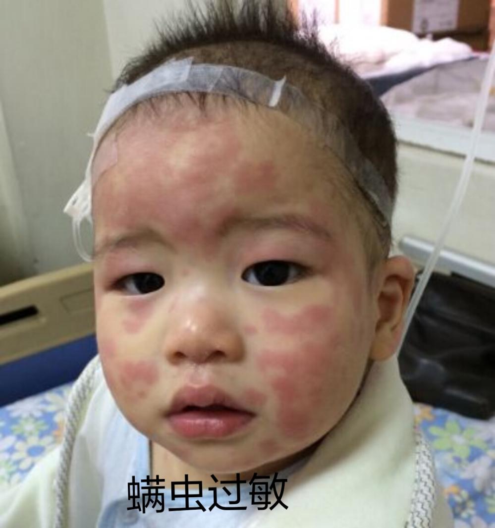 3岁宝宝突发荨麻疹, 医生说是因为妈妈给儿子