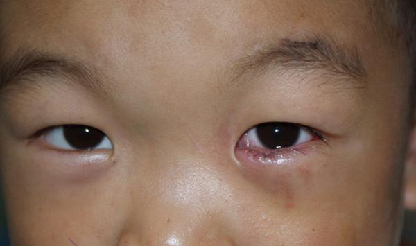 婴儿角膜炎的症状图片图片