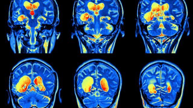 科学家发现了在大脑中造成忧郁症的实体来源