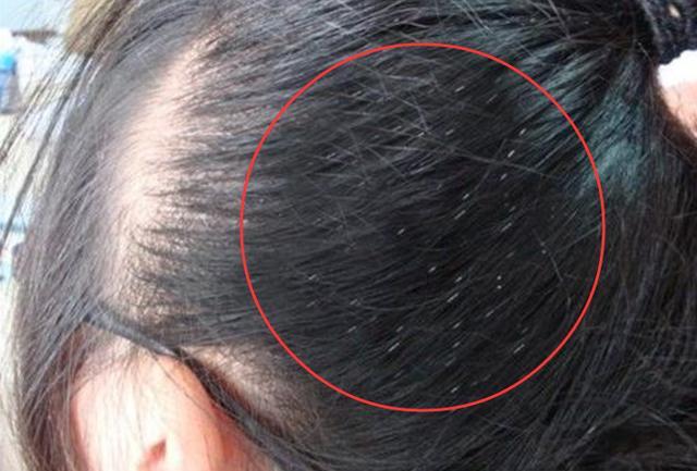 头上长的一串一串"小白卵"是什么东西? 可能是3物, 人人都有