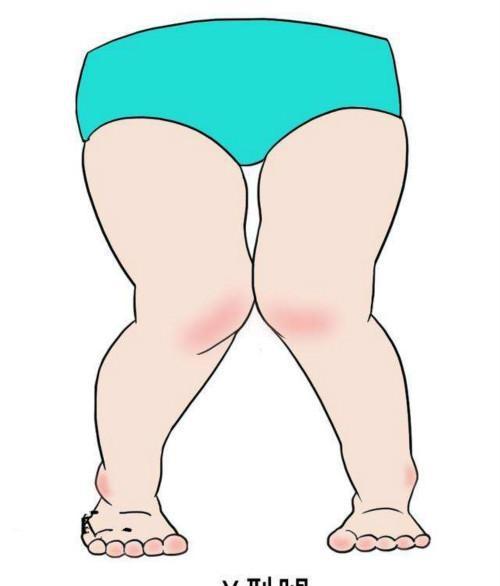 o型腿◆ 特点:o型腿又称为罗圈腿,在瘦子中很常见.