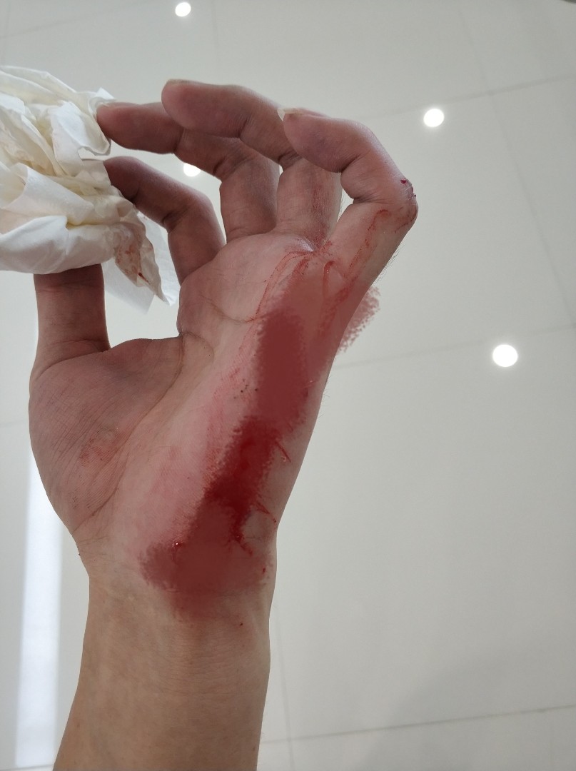 了,血哗啦哗啦流,滴到我的鞋子上,幸好同事安排了救护车在外面侯着