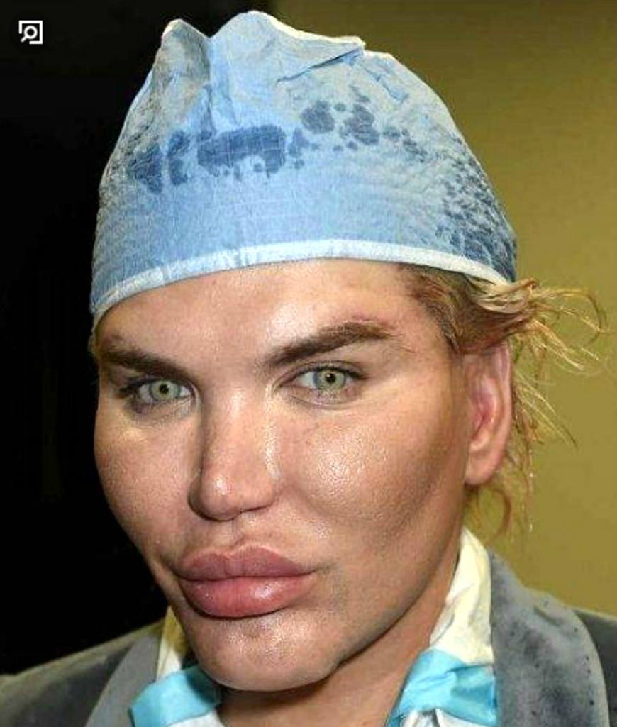 整容男子公开自己24岁照片,阳光帅气的他被自已搞成这幅鬼样