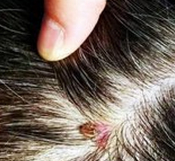 孩子头上长了个包,发烧就没停过而且总头疼,扒开头发吓了一跳|蜱|虱子