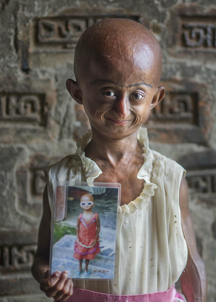 花季女孩患上早衰症,被当作怪物对待,医生断定她只能再活2年