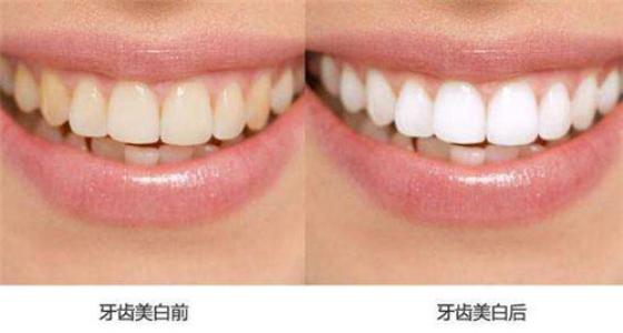 牙齿快速变白的小技巧