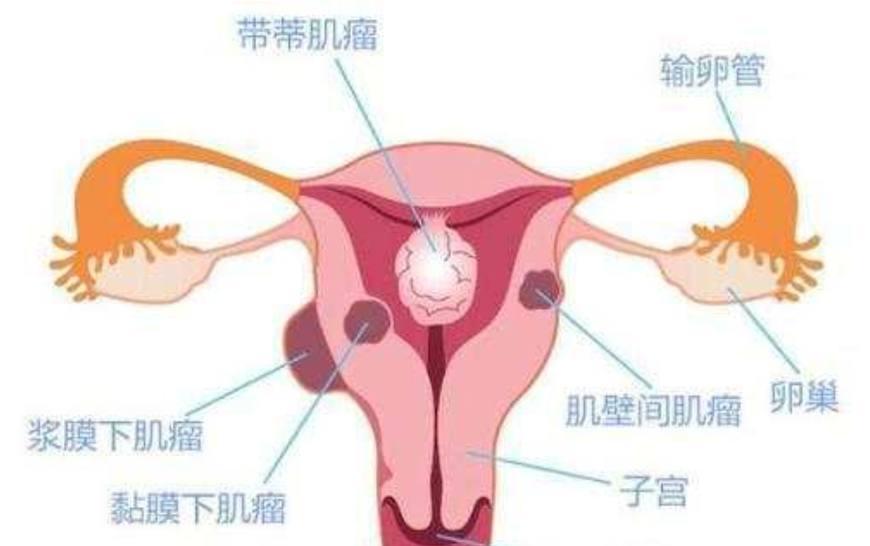对子宫肌瘤有疑惑? 是否影响生育? 这里帮你解决五大难题!