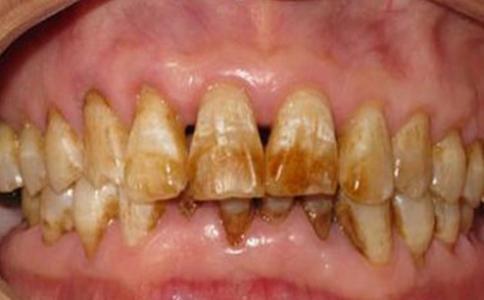 有很严重的损伤;破坏牙釉质,容易长出牙菌斑,牙菌斑有益于蚜虫的驻足