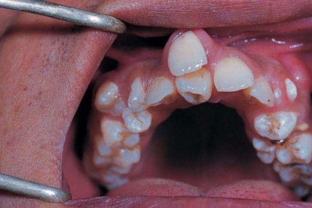牙齿畸形难看图片