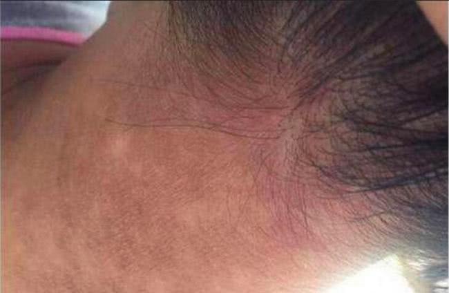 男孩脖子上出现一圈黑,怎么洗也洗不掉,医生检查后爸妈尴尬的笑