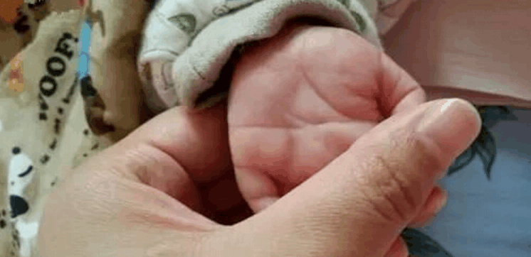 宝宝的满月酒席上弟弟看到宝宝断掌纹立即将孩子送到了医院检查