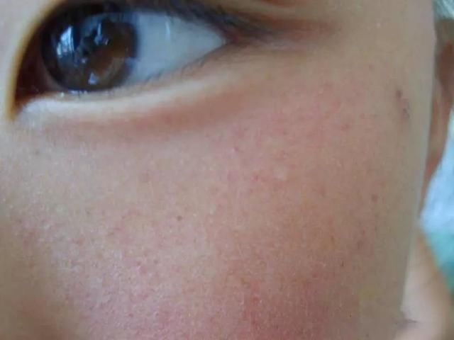 一例面部紫癜的思考!