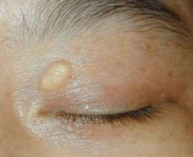 脸上长"黄色瘤",说明血脂已超标,农村1种豆能让血脂乖乖降