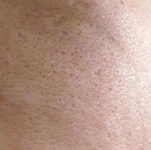 当你脸上有这4种表现时,说明有上万螨虫在打洞,现在消灭还不晚|海盐|