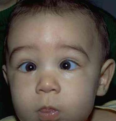 婴儿对眼儿正常吗?小孩内斜视