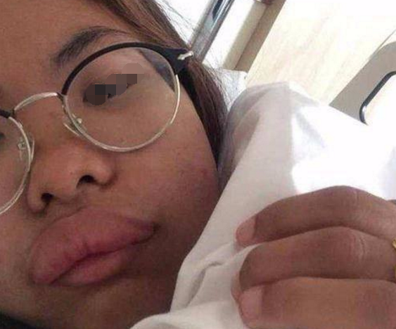 孕妇因对酸奶过敏早上起来变成香肠嘴怕丢人不敢去医院治疗