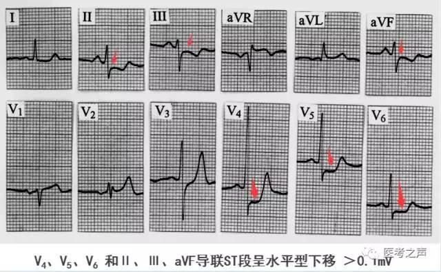 稳定型心绞痛到底是什么稳定