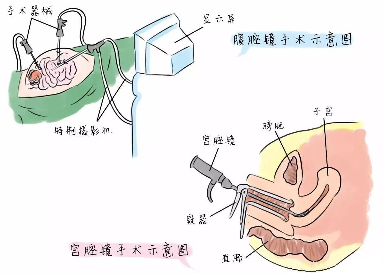 子宫内息肉行宫腔镜手术摘除是否对身体有伤害
