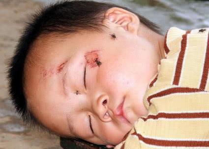 夏季宝宝被蚊子咬个包,妈妈如此做让孩子高烧两天差点要了命!