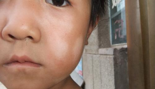 宝宝有这几种症状就是身体里面有蛔虫了,家长需谨慎|蛔虫|家长|白斑