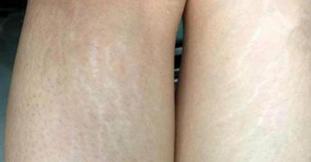 橘皮|扎心|生长纹_新浪新闻