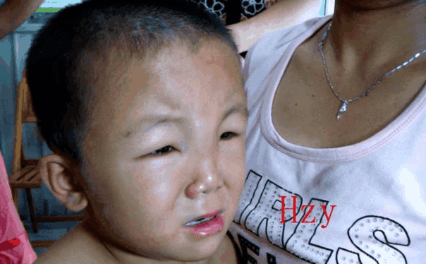 终成肾脏衰竭家长痛哭流涕|肾病综合征|浮肿|眼皮_新浪新闻