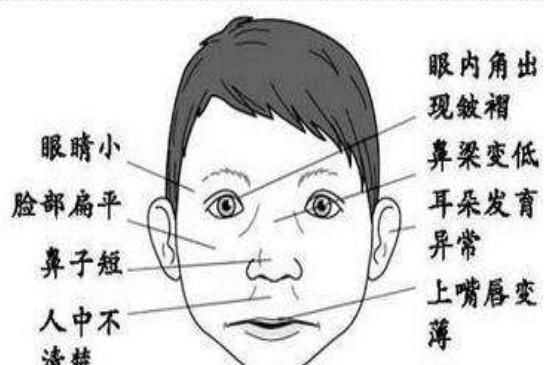 "胎儿酒精中毒综合征就算受到酒精损伤的精子使卵子受孕,也有能会生出