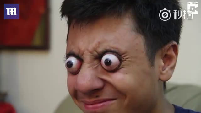 可怕!胆小慎点,16岁男孩能将眼睛瞪出眼眶超过12毫米