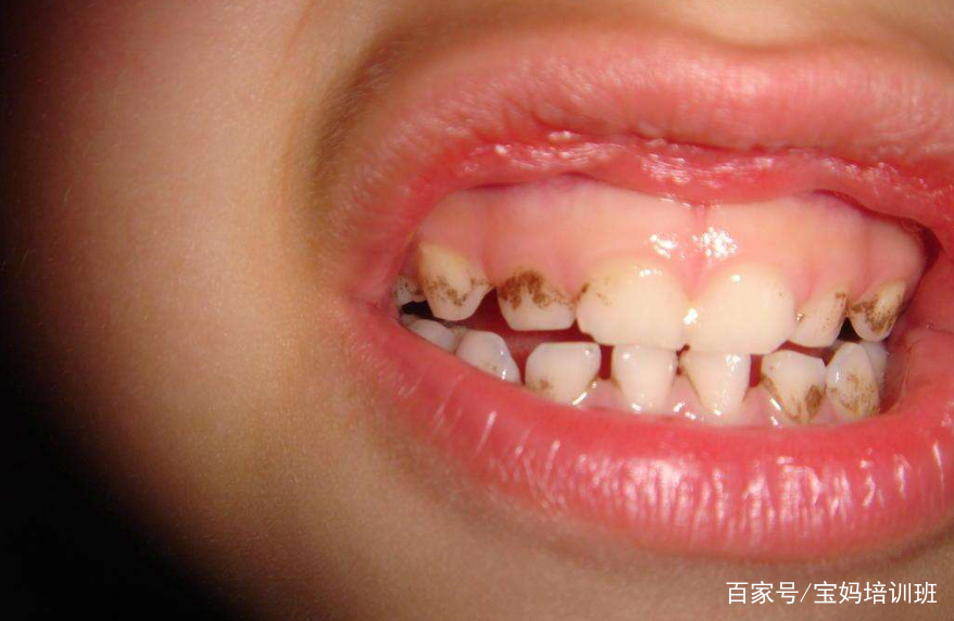 如何预防婴儿蛀牙,这几个方法很好用|蛀牙|婴儿|龋齿_新浪新闻