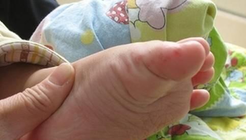 手足口|疱疹|手足口病_新浪新闻