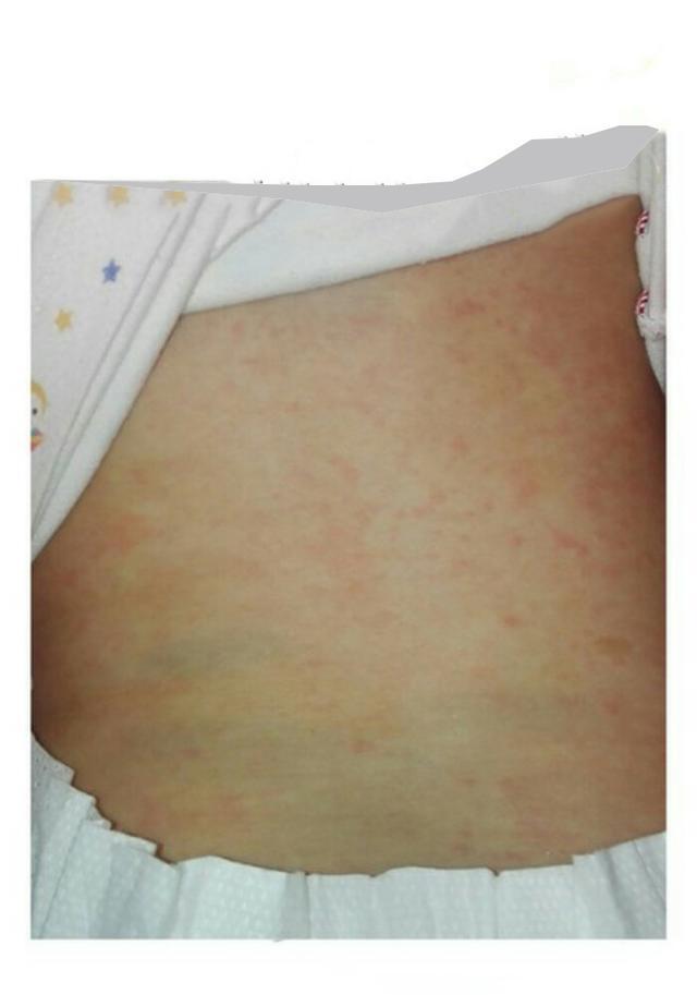 宝宝感染梅毒的症状图图片