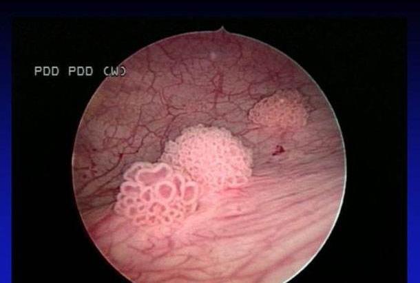男孩被查出膀胱肿瘤