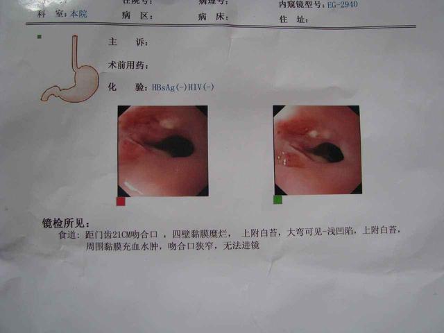 诱发食道癌的病理性原因和饮食问题!